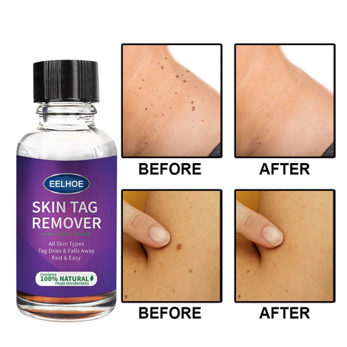 Foreign Trade Cross-Border Eelhoe Skin Verrucous Remover To Solve Skin Verrucous - stancevita