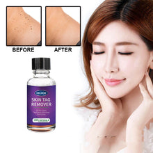 Charger l&#39;image dans la galerie, Foreign Trade Cross-Border Eelhoe Skin Verrucous Remover To Solve Skin Verrucous - stancevita
