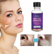 Charger l&#39;image dans la galerie, Foreign Trade Cross-Border Eelhoe Skin Verrucous Remover To Solve Skin Verrucous - stancevita
