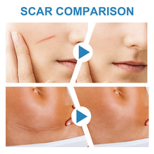 Lade das Bild in den Galerie-Viewer, UV Light Scar Pen Gentle Fade Repair Skin Scar Smooth Skin Light Scar Pen - stancevita
